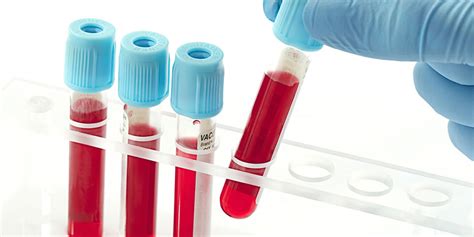 Rezultatele testelor de sânge pentru diabet